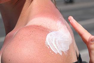 Stephanie Pilick/dpa/dpa-tmn | Bei Sonnenbrand ist Hautpflege gefragt: Feuchtigkeitsspendende Lotionen mit Aloe vera helfen der geschädigten Haut.